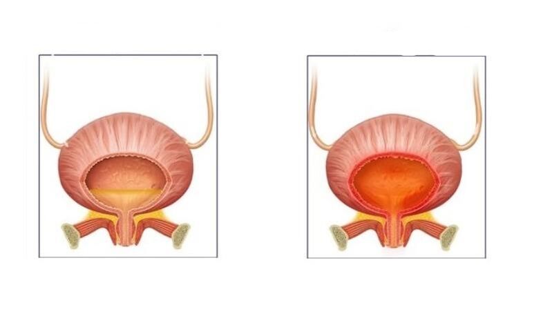 Normální a pacienti s cystitidou močového cesty
