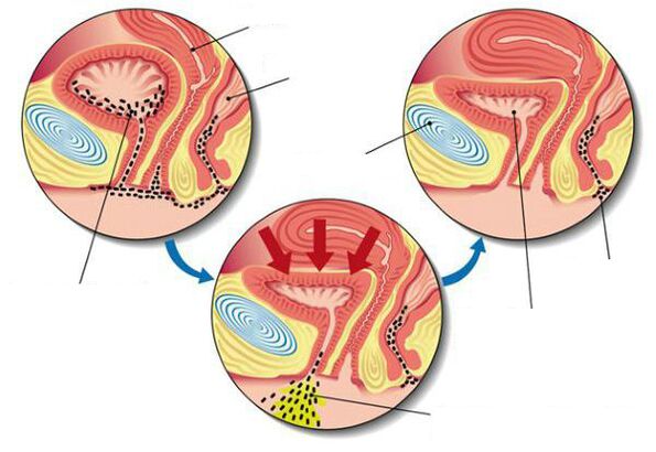 bakterie v močovém měchýři s cystitidou