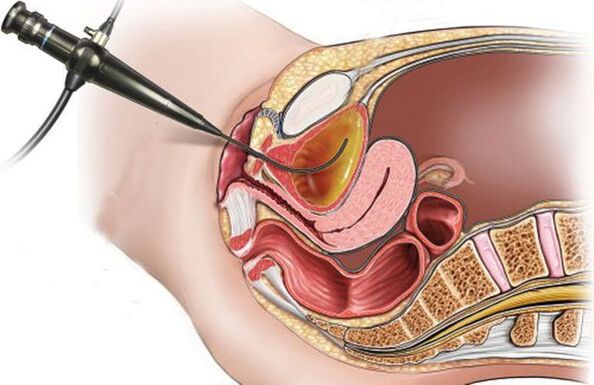 cystoskopie pro cystitidu