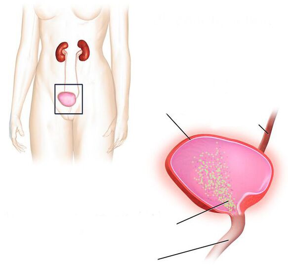 zánět močového měchýře